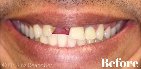 Bridge before