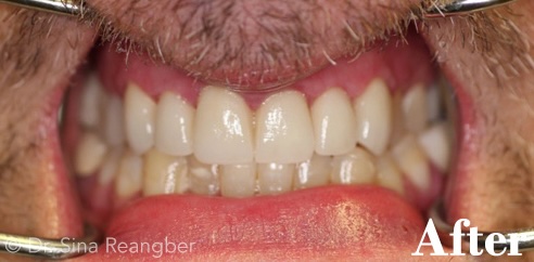Crowns after