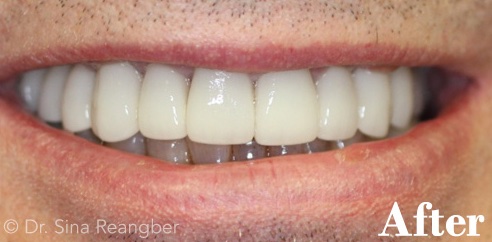 Crowns after
