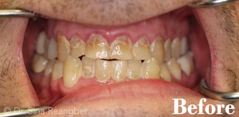 Crowns before