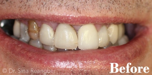 Crowns before