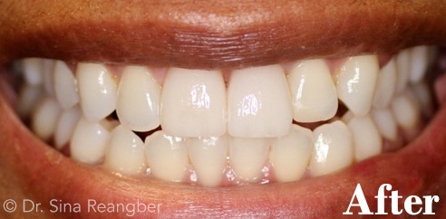 Crowns after