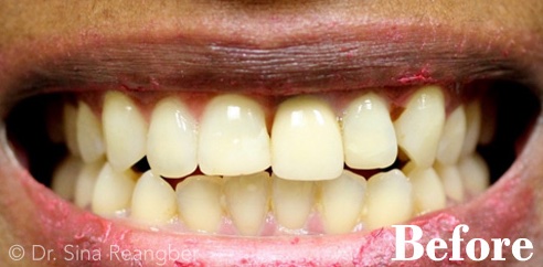 Crowns before