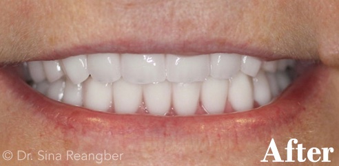 Dentures after