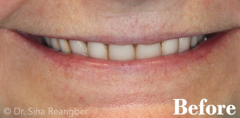 Dentures before