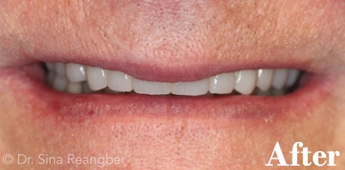 Implant crowns after