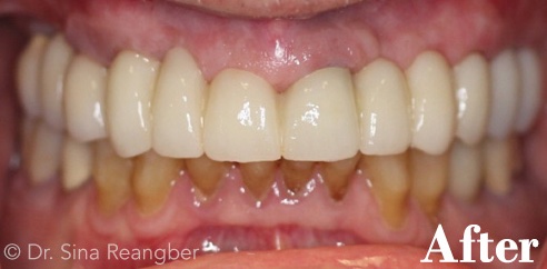 Implants after 2