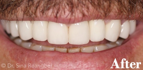 Implants after 1