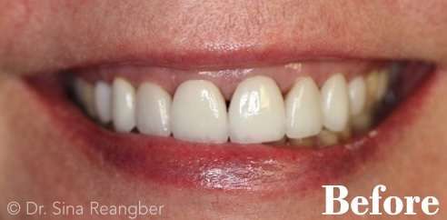 Veneers before