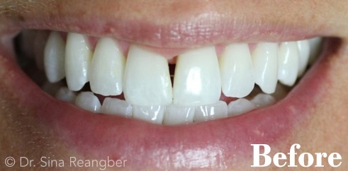 Veneers before