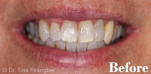 Whitening before