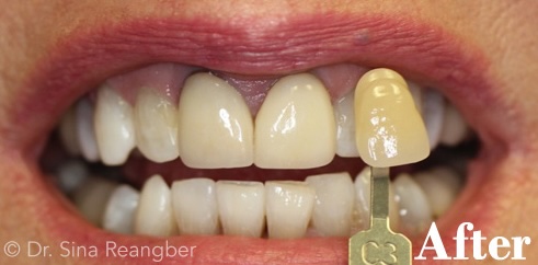 Whitening after