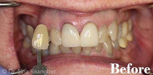 Whitening before