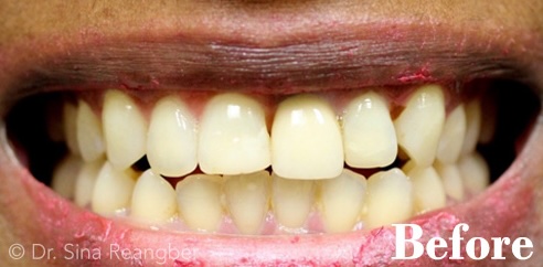 Whitening before